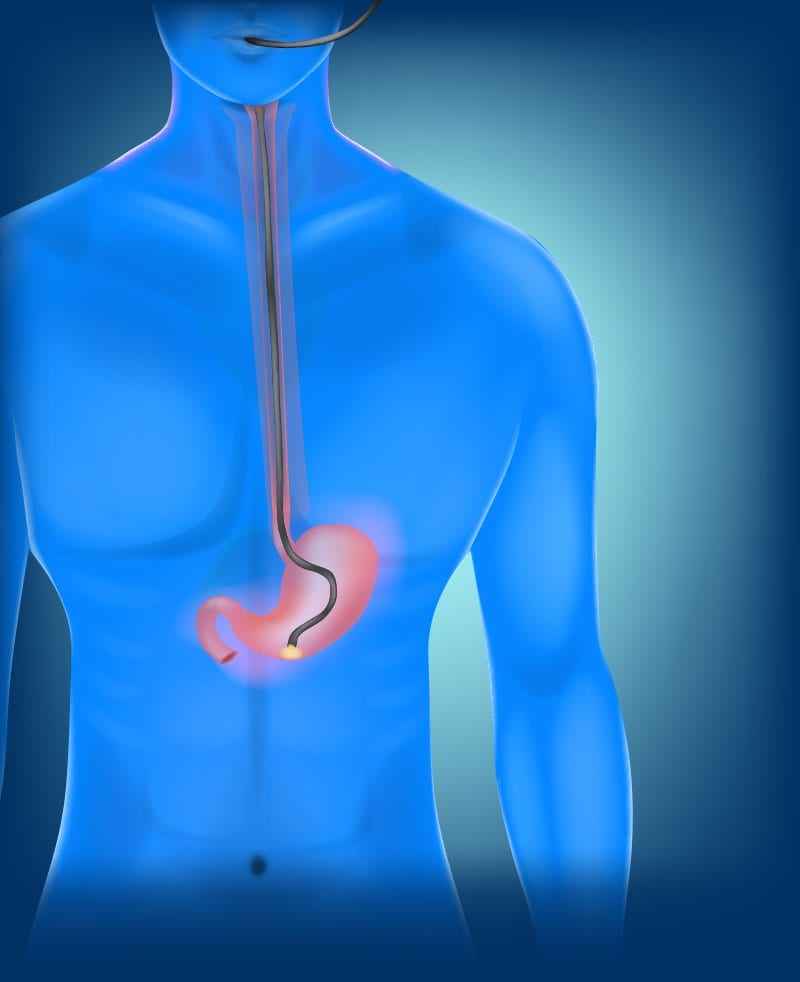 UPPER ENDOSCOPY Gastroenterology Consultants of LaredoGastroenterology Consultants of Laredo